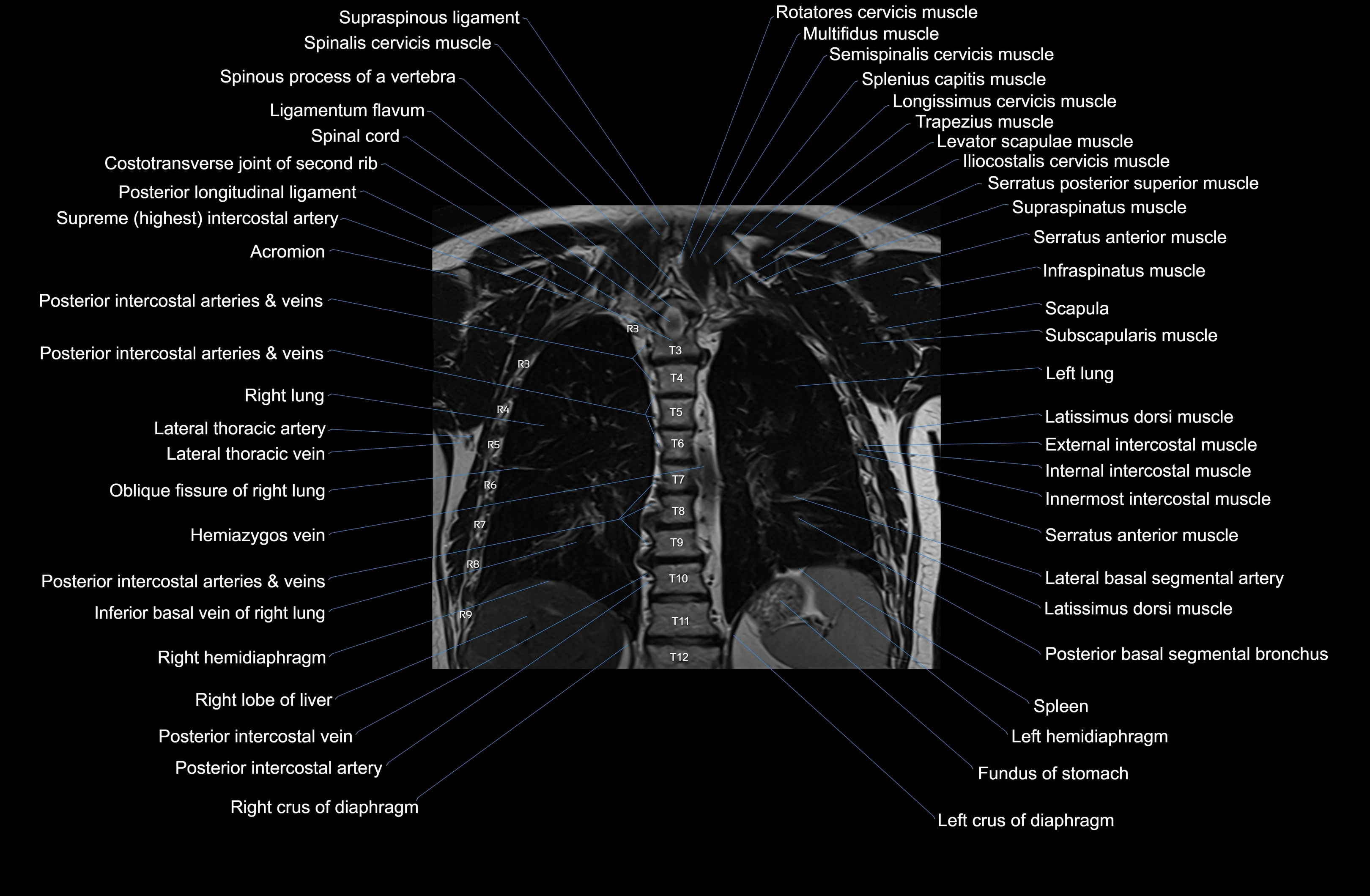 MRI chest (thorax) coronal  cross sectional anatomy 3T radiology  image-img-00001-00030.webp